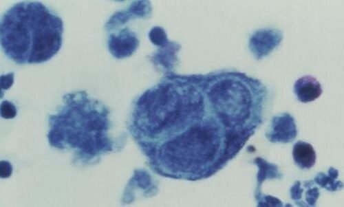 La nueva vacuna del herpes zóster reduce en casi un 90% los casos de la enfermedad entre mayores de 80 años