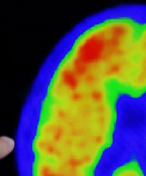 La financiación pública de los nuevos tratamientos para el alzhéimer abre una crisis entre Sanidad y la gran farmacéutica Eli Lilly